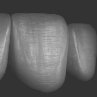 Detalhe técnico de prótese dentária publicado pela DuoDente