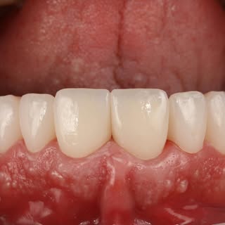 Detalhe técnico de prótese dentária publicado pela DuoDente