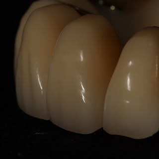 Detalhe técnico de prótese dentária publicado pela DuoDente